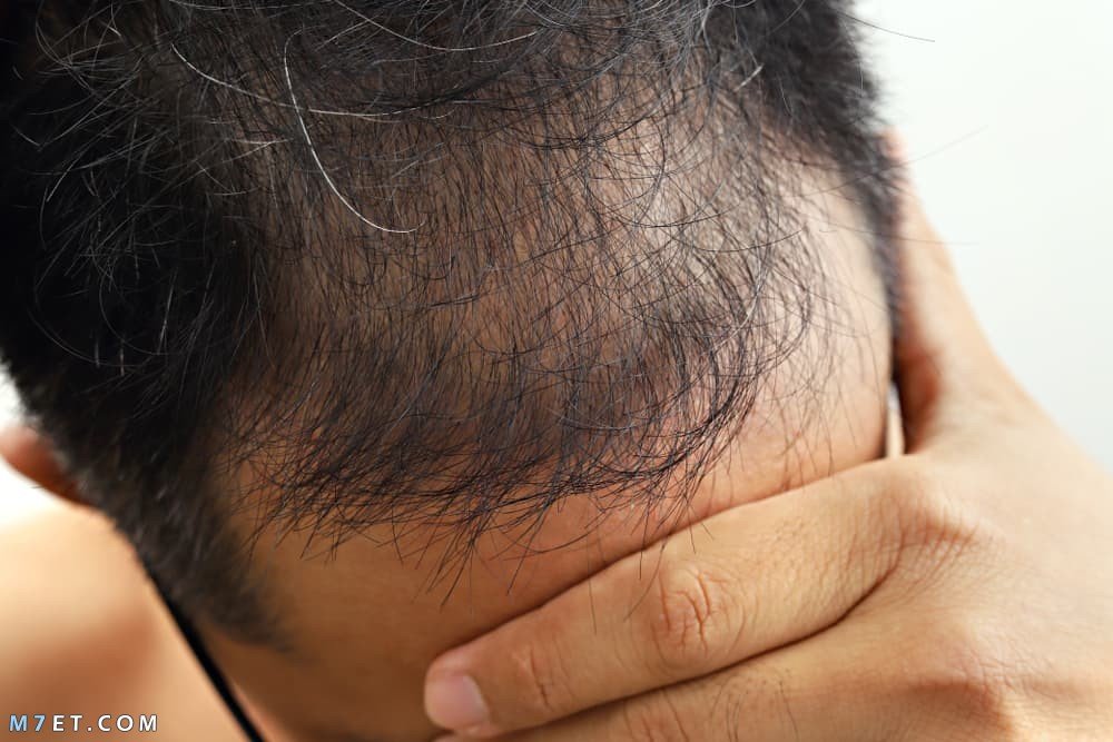 What is the difference between hair transplant techniques and hair transplantation 1 Photo No. 4 hair transplant techniques