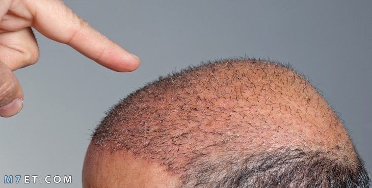 What is the difference between hair transplantation techniques Hair transplantation 3 Picture No. 2 hair transplant techniques